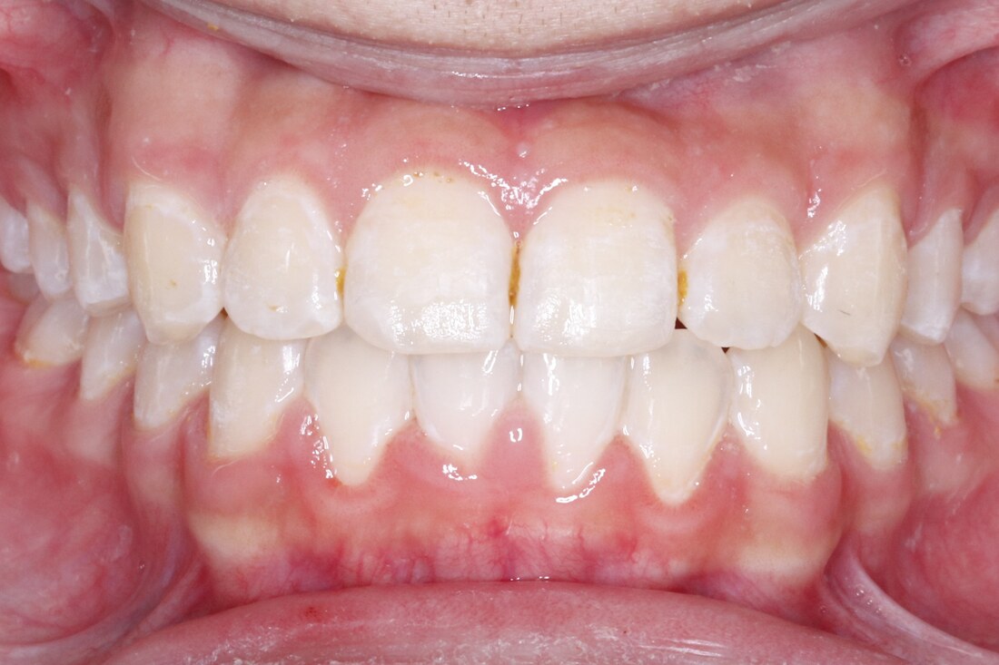 After treatment: the same arches aligned and meeting evenly
