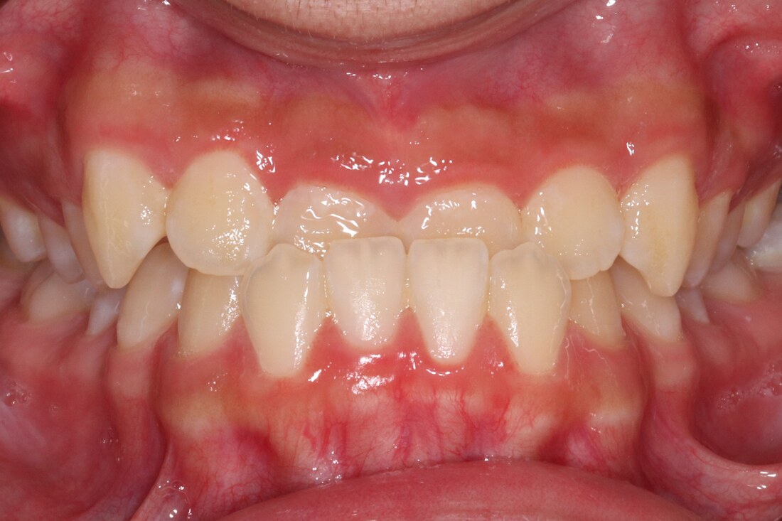 Before treatment: crowded and overlapping front teeth with an uneven bite