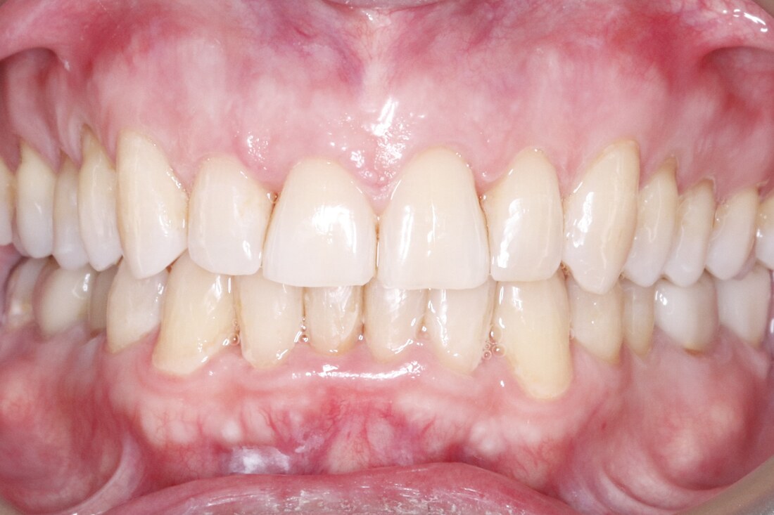 After treatment: the bite levelled and the front teeth even