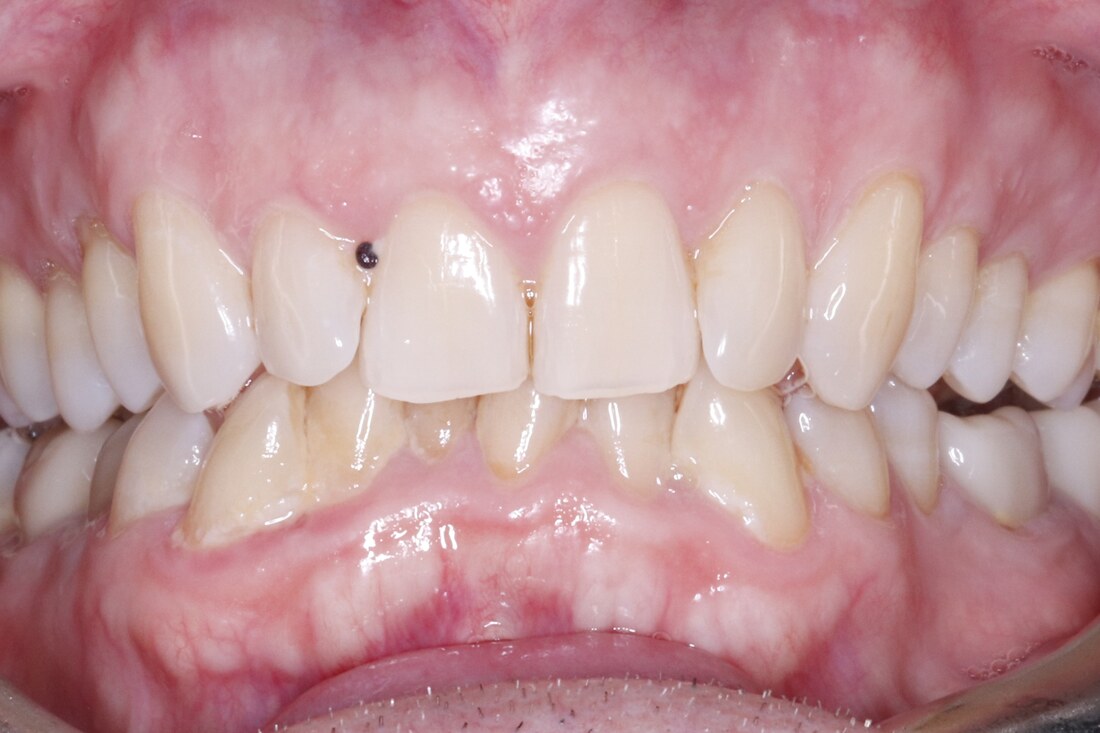 Before treatment: uneven front teeth with worn edges and an irregular bite