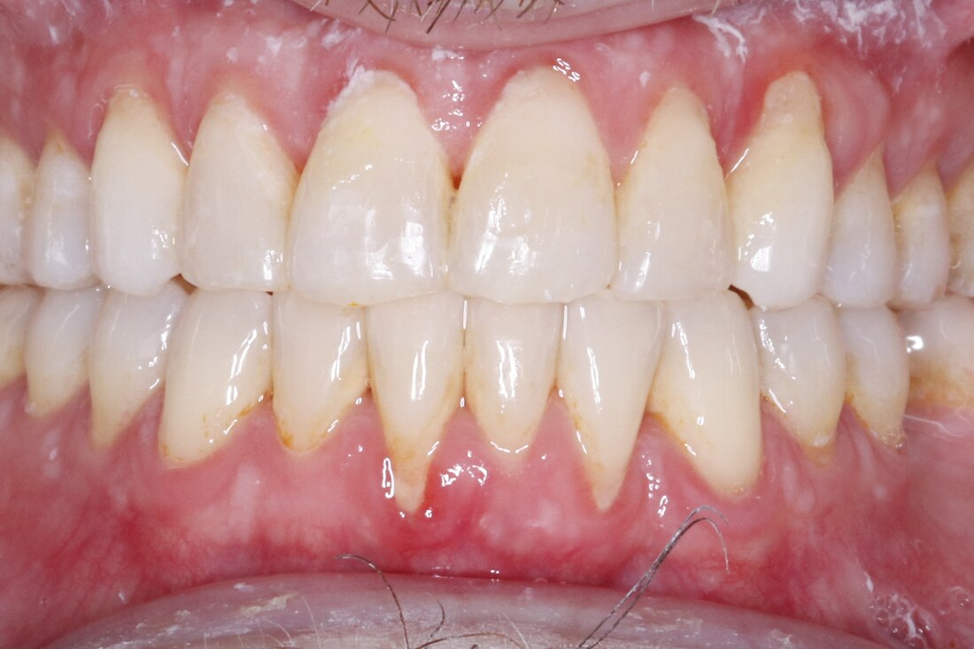 After treatment: both arches aligned into an even curve