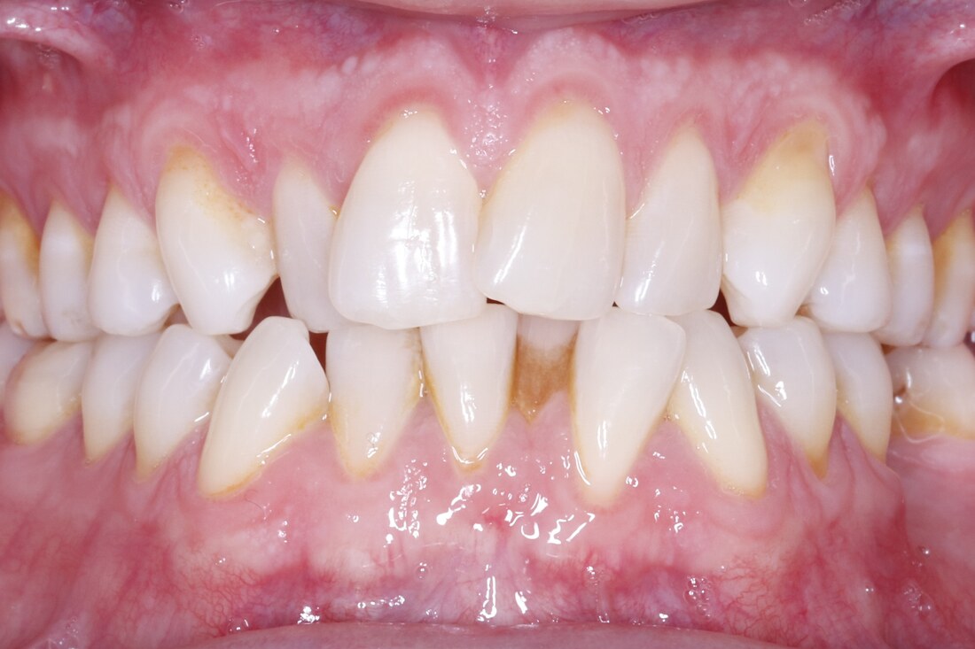 Before treatment: crowded and rotated teeth in both arches