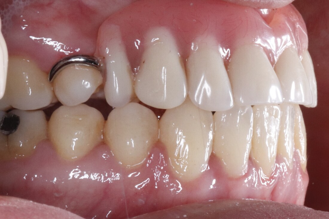 After treatment: the same side view with the back teeth settled into a proper bite
