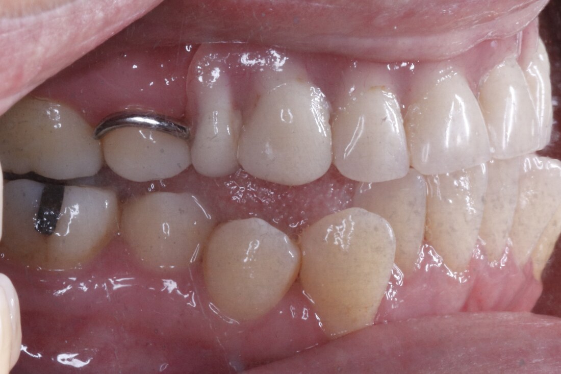 Before treatment: the back teeth from the side, not meeting evenly, with gaps along the arch
