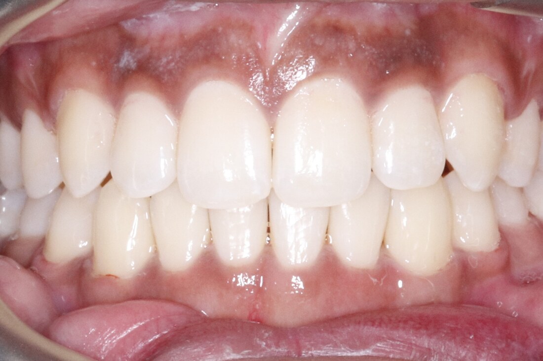 After treatment: the rotations corrected and the gaps closed