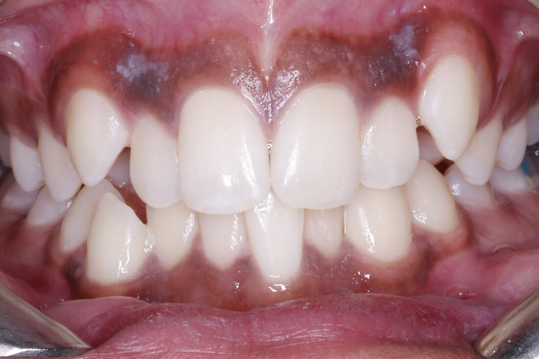 Before treatment: rotated front teeth with dark triangular gaps between them