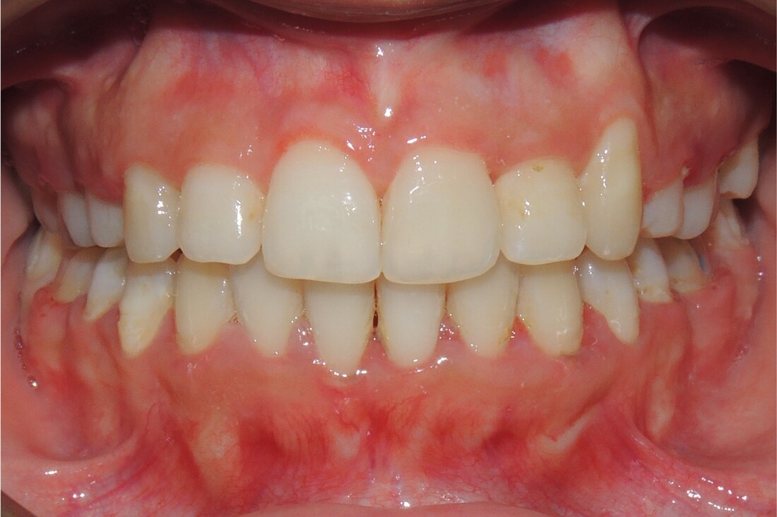 After treatment: the canine brought down into line with the rest of the arch