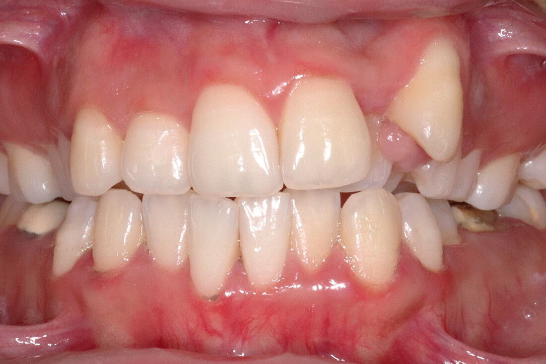 Before treatment: a canine pushed out of the arch above crowded front teeth