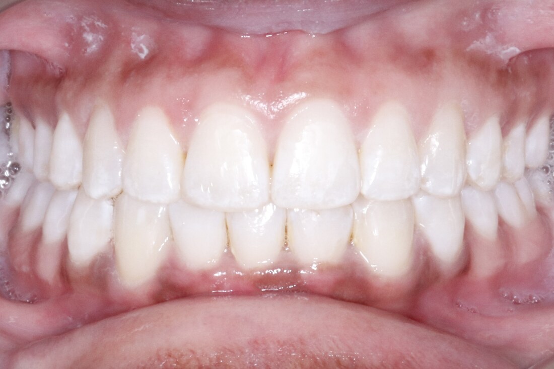 After treatment: the lower arch aligned with the canine in position