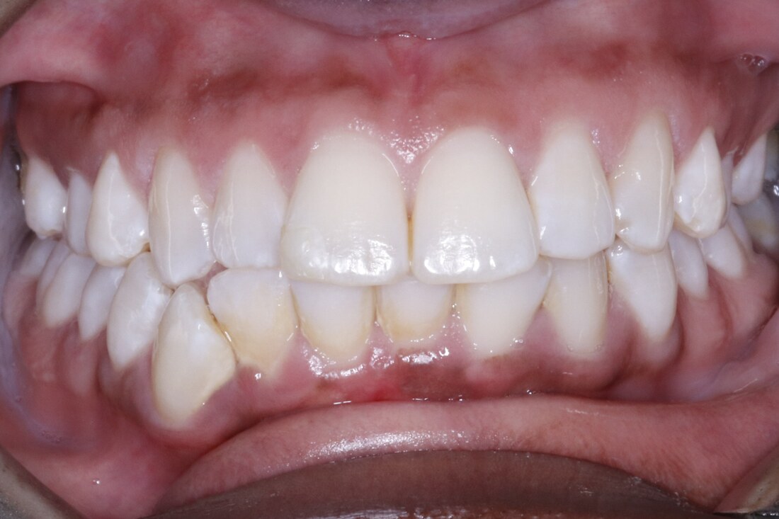 Before treatment: a lower canine displaced forward out of a crowded lower arch