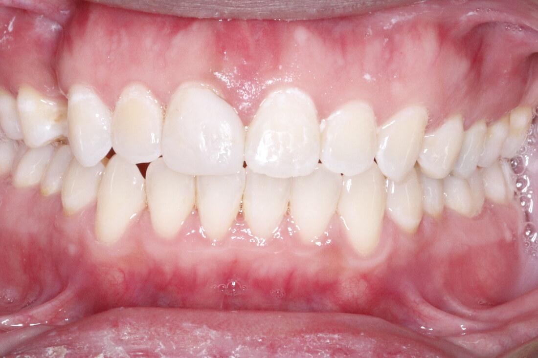 After treatment: the spaces closed and the front teeth meeting