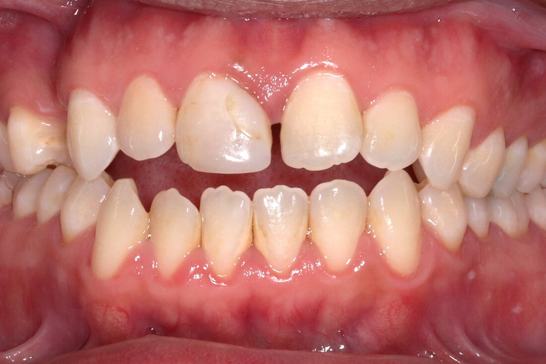 Before treatment: front teeth apart with visible spacing and an open bite