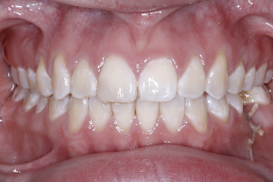 After treatment: the same teeth rotated into line with the spaces closed