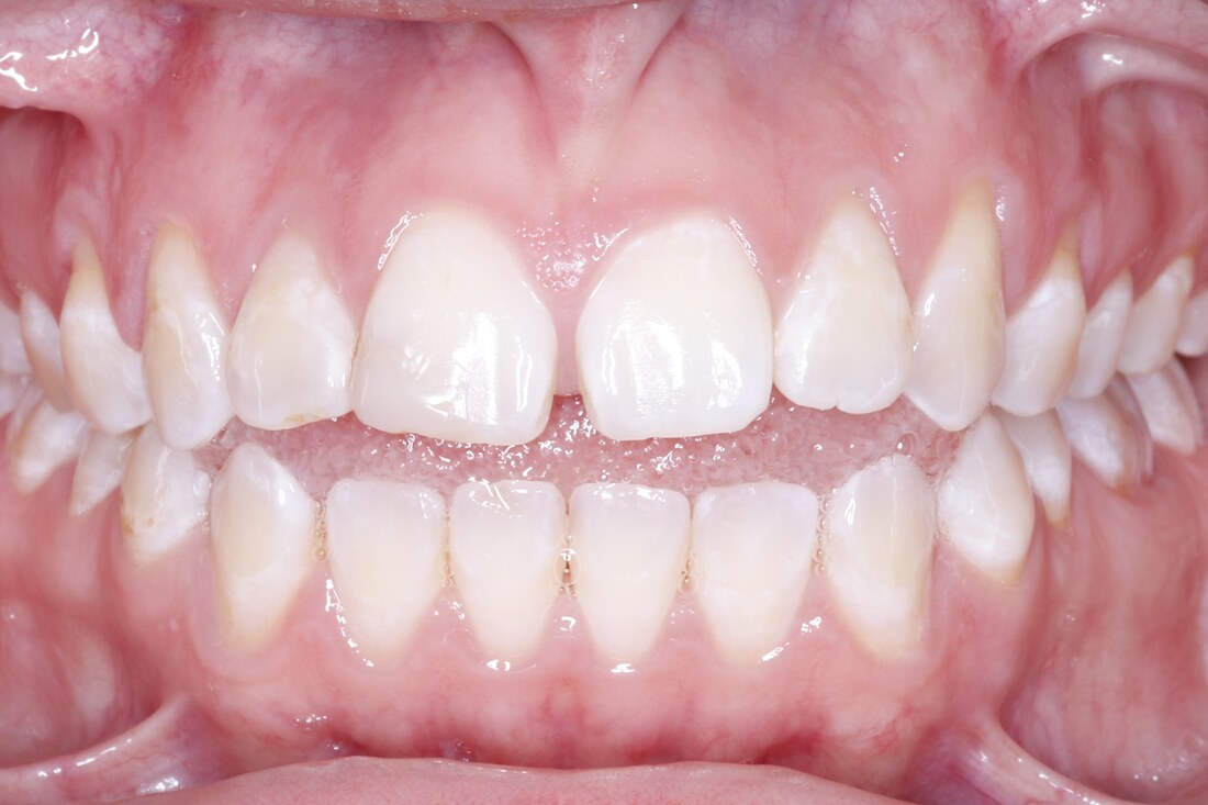 Before treatment: rotated upper front teeth with gaps between them