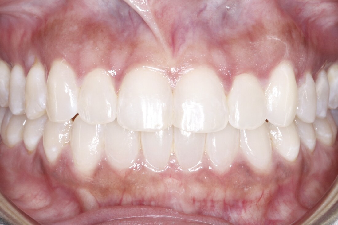 After treatment: the contacts closed and the arch evened out