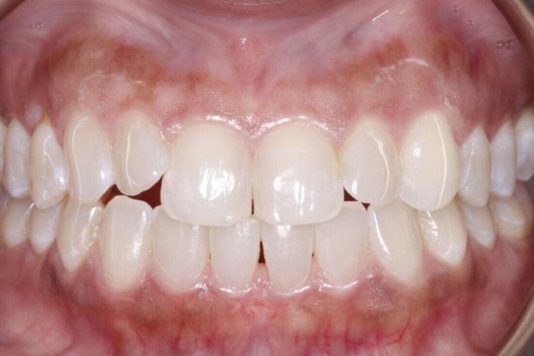 Before treatment: gaps between the front teeth and an uneven arch
