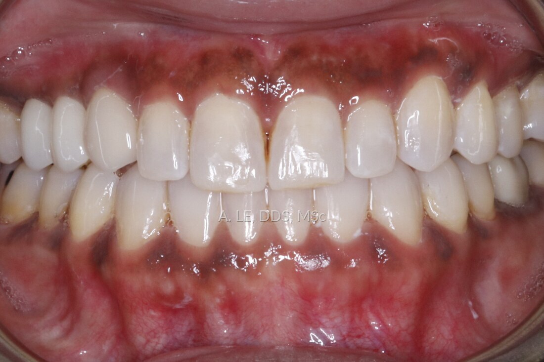 After treatment: the arch even and the front teeth level