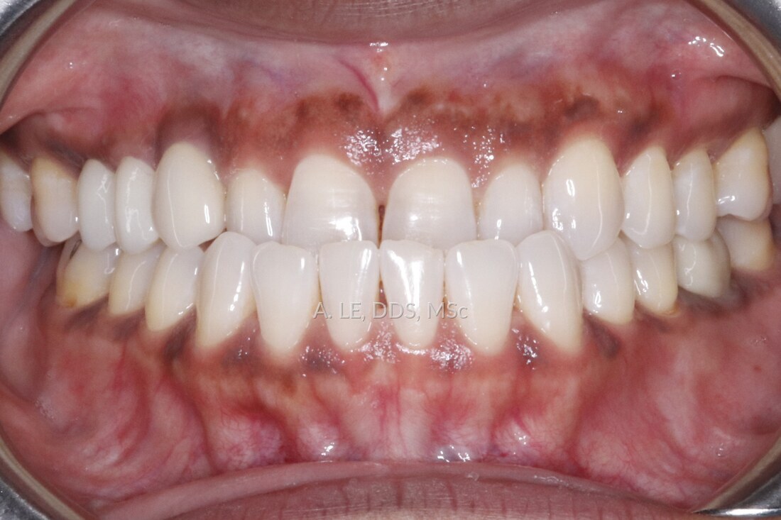 Before treatment: rotated upper side teeth and an uneven edge to the front teeth