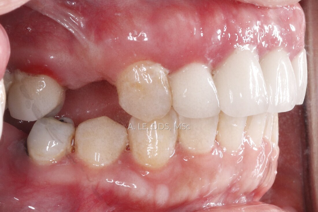 After treatment: the same side view with the teeth upright and in line, and the space evenly shaped