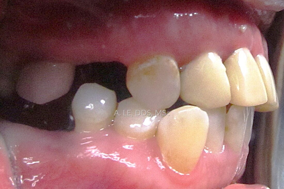 Before treatment: a side view with teeth tipped and rotated into a gap, and a canine sitting outside the arch