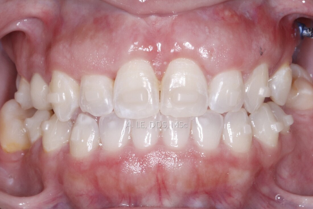 After treatment: the gap closed and the right side biting correctly over the lower teeth