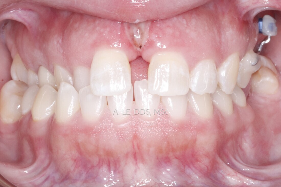 Before treatment: a large gap between the upper front teeth, with the right side biting inside the lower teeth