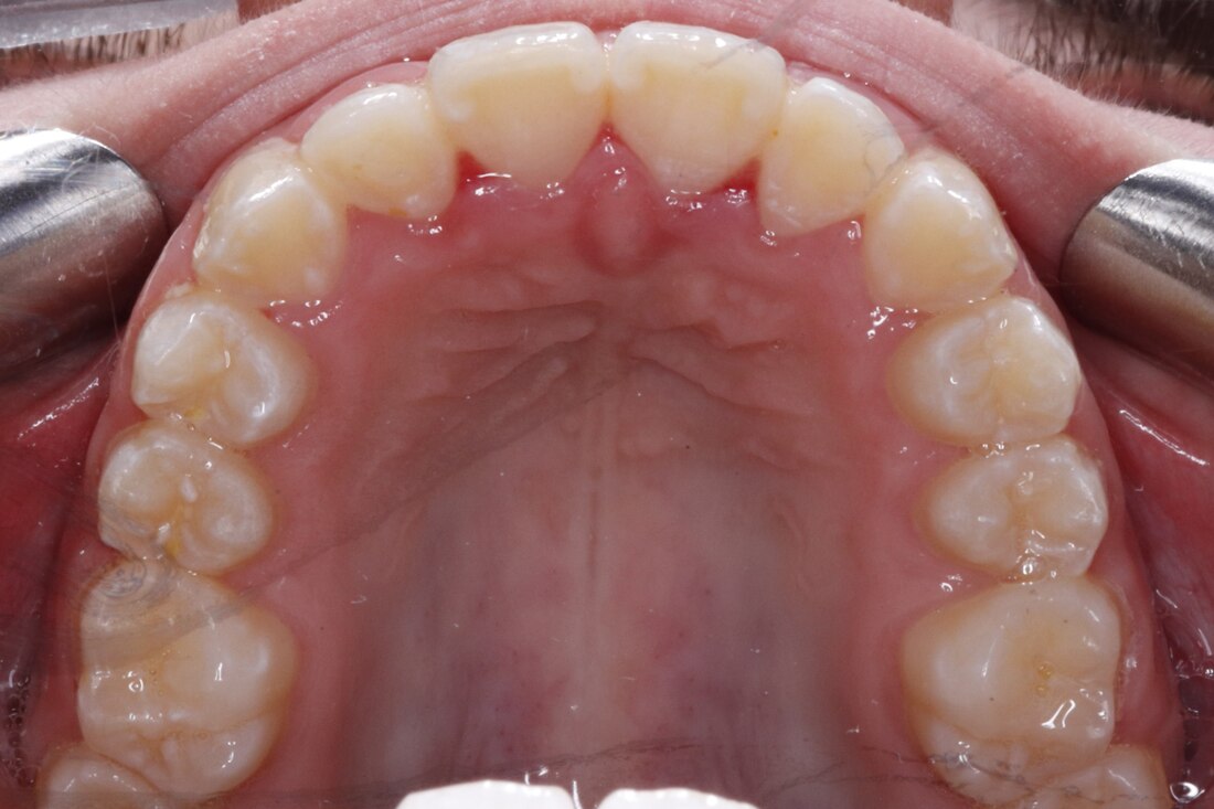 After treatment: the same upper arch from above, now a smooth even curve with every tooth in line