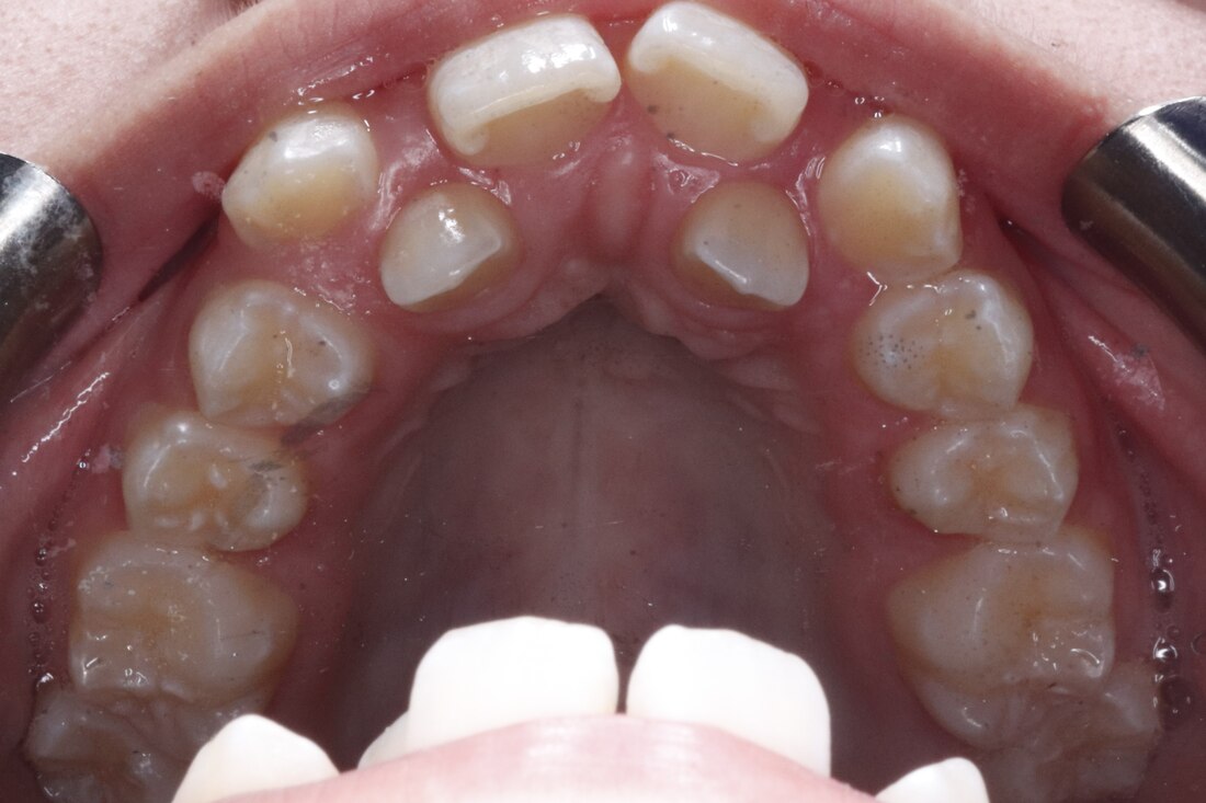 Before treatment: view of the upper arch from above, showing severe crowding with the side teeth blocked out of the arch