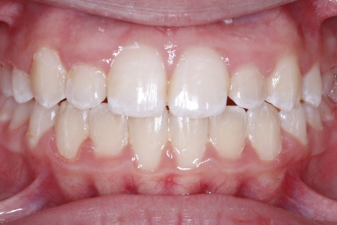After treatment: canines brought into the arch and the front teeth aligned
