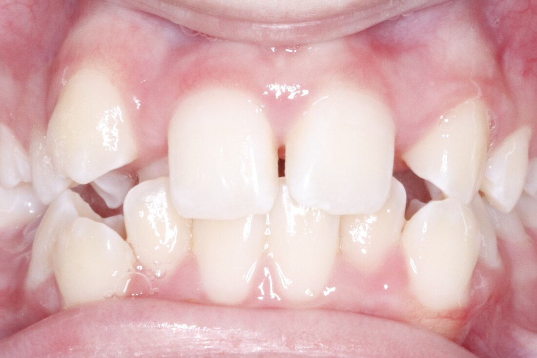 Before treatment: displaced canines and irregular front teeth