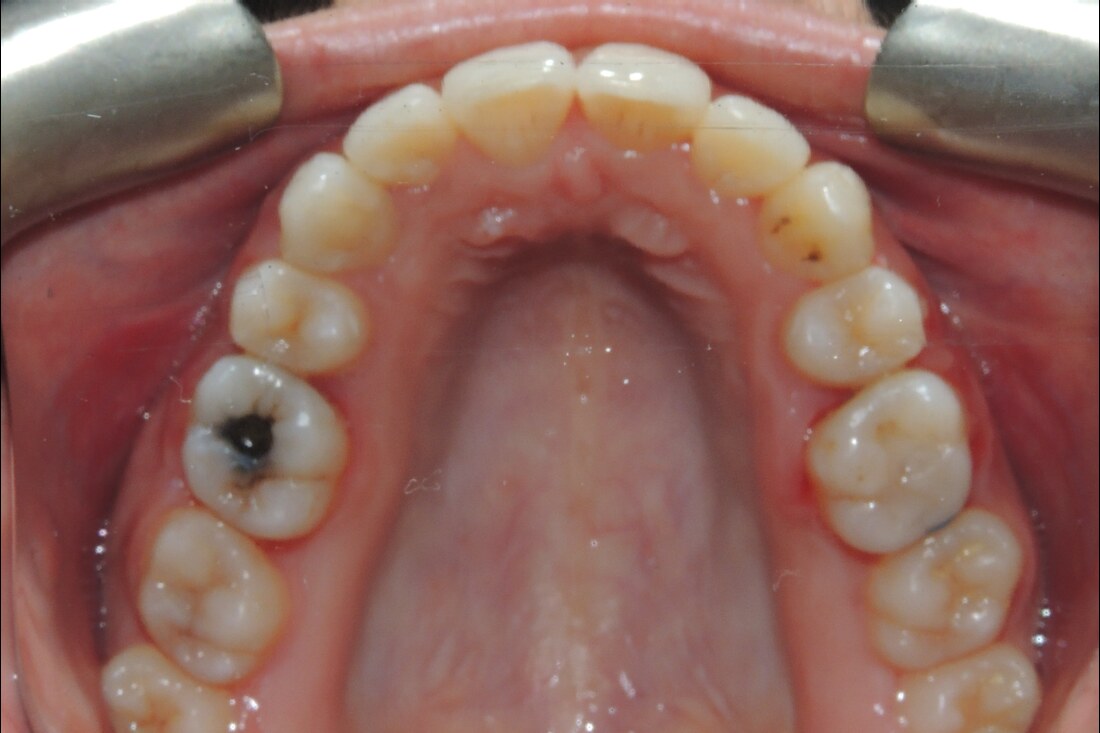 After treatment: the same upper arch widened into an even curve