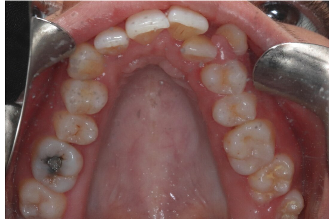 Before treatment: the upper arch from above, irregular and narrow through the back teeth