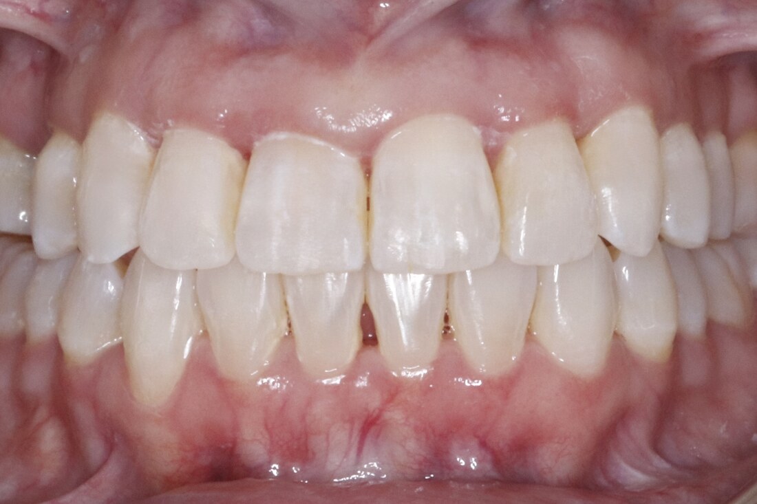 After treatment: the gap closed and the teeth meeting evenly