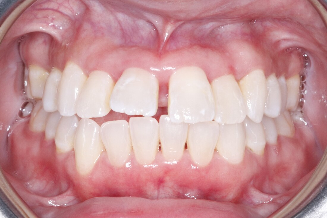 Before treatment: a gap between the upper front teeth and open contacts along the arch