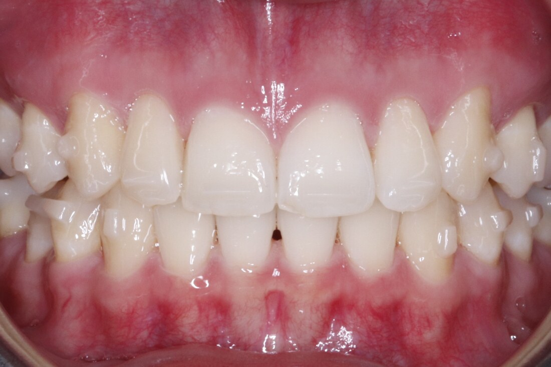 After treatment: the front teeth derotated and evenly aligned