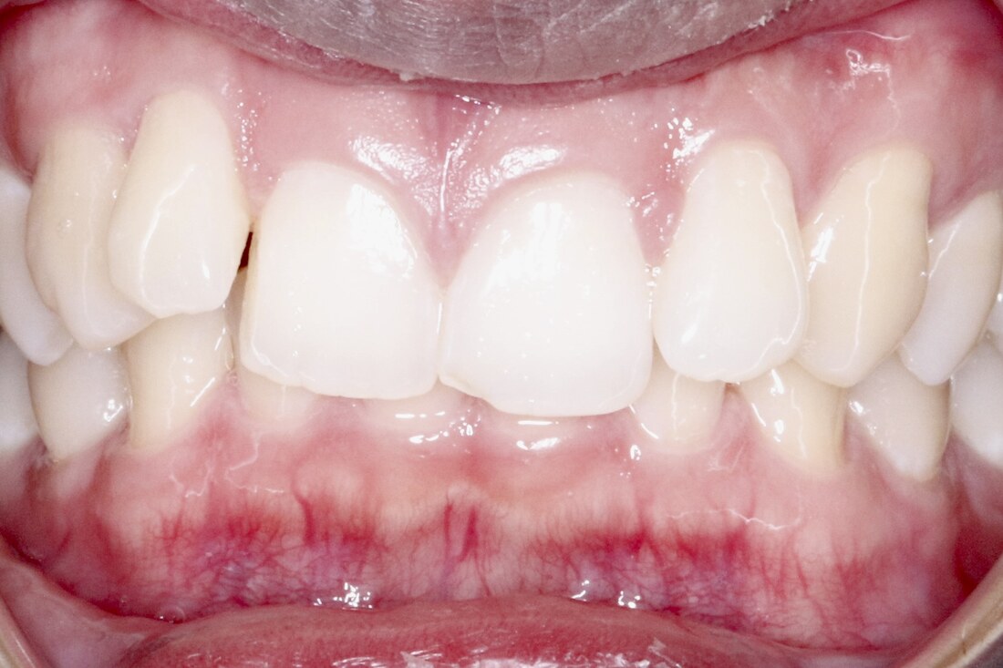 Before treatment: rotated and crowded front teeth with uneven spacing