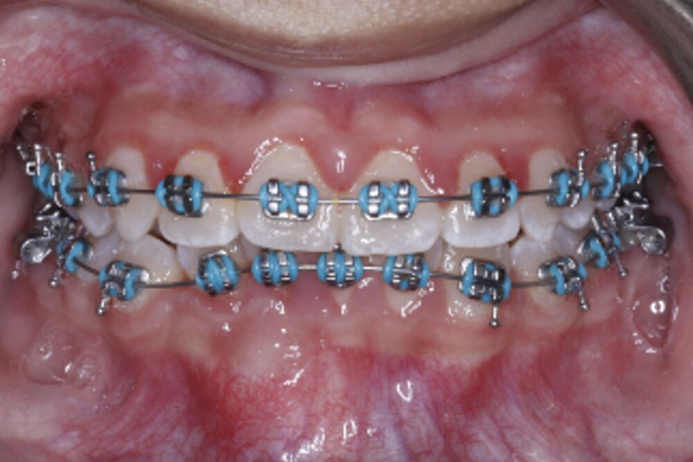 Fixed braces bonded to the upper and lower teeth, with an archwire held by coloured elastic ties