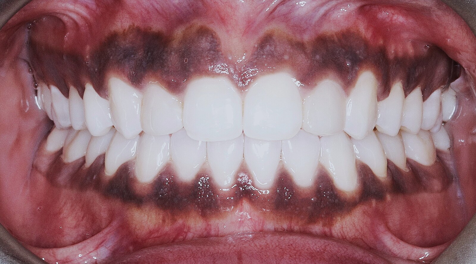 Intraoral photograph of the same patient after treatment, gap closed and bite aligned