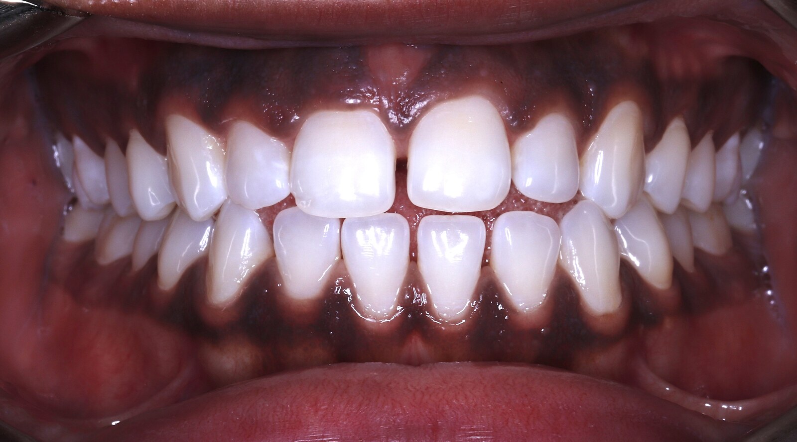 Intraoral photograph before orthodontic treatment, showing a gap between the front teeth and an uneven bite