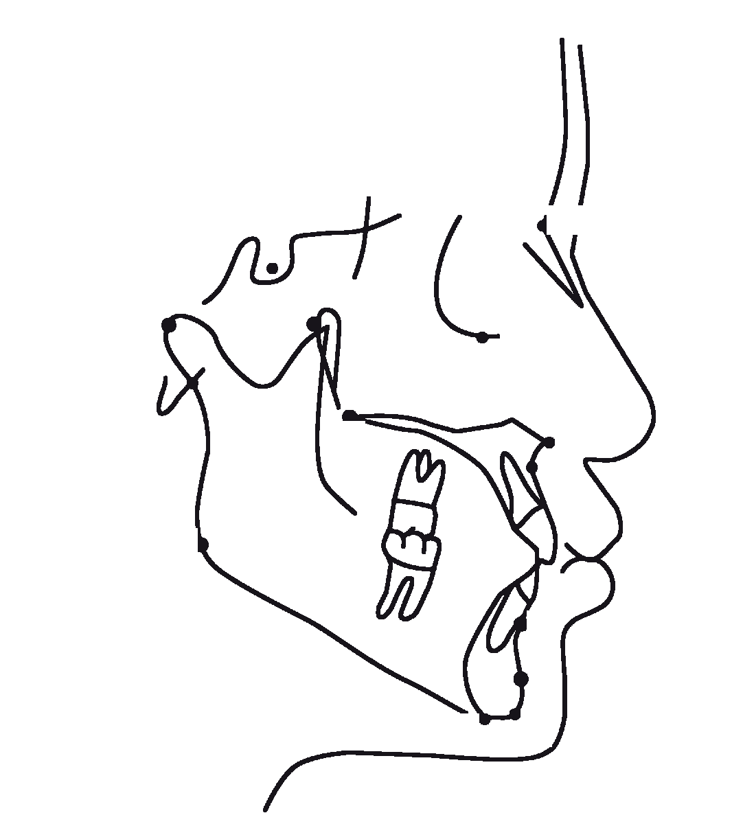 Cephalometric tracing: a line drawing of the skull in profile with the skeletal landmarks marked